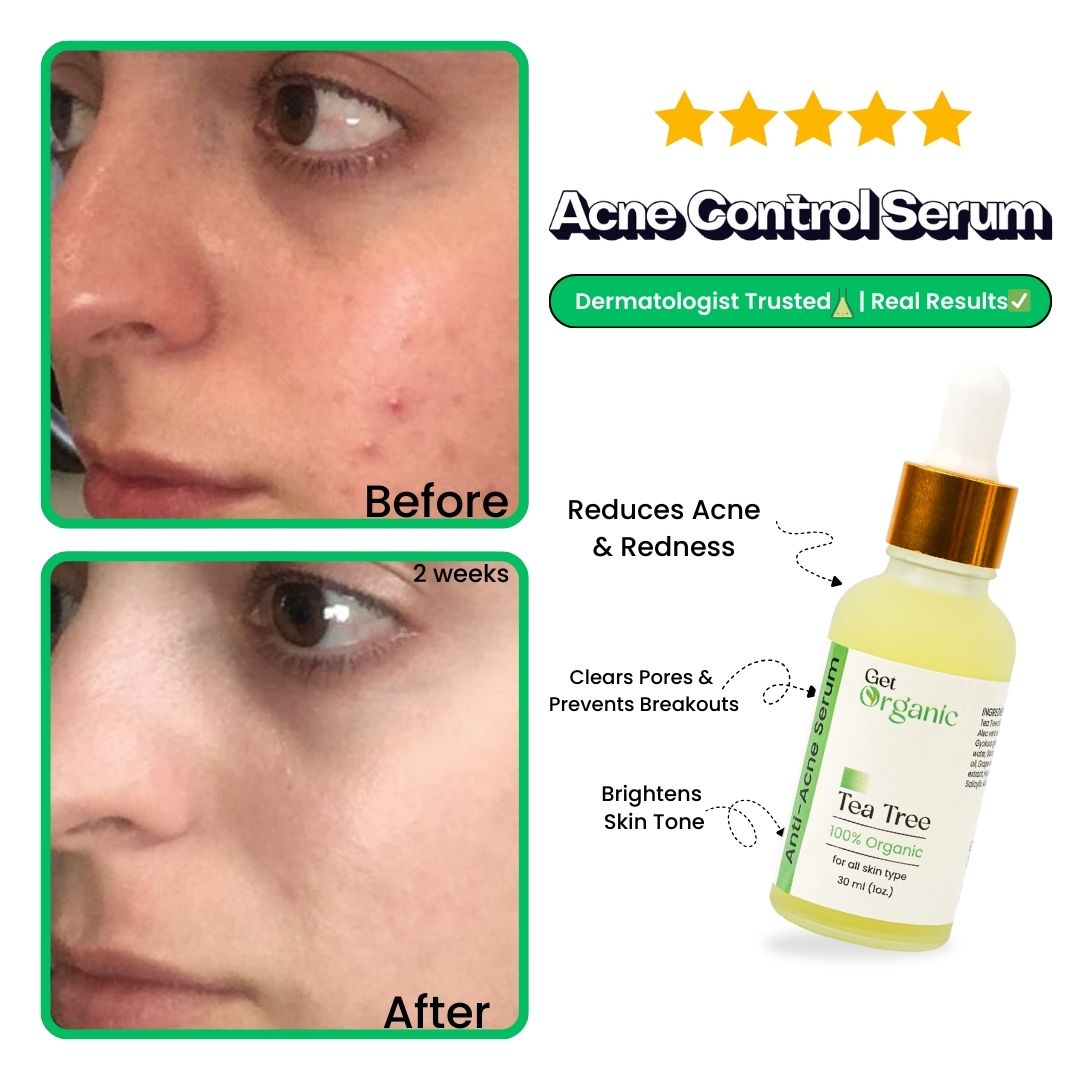 Anti-Acne Serum - GetOrganic