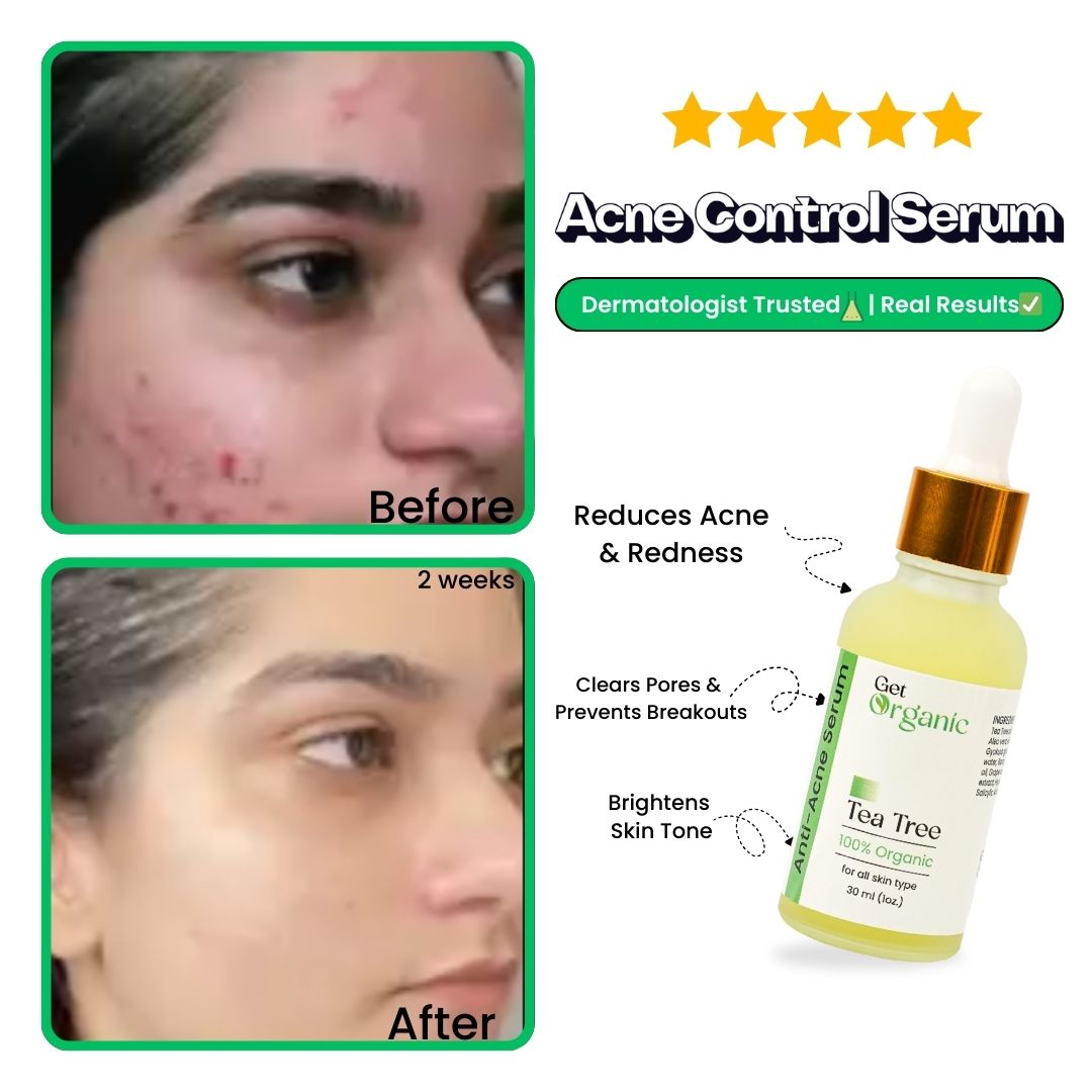 Anti-Acne Serum - GetOrganic
